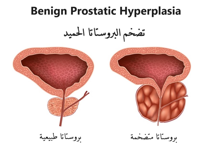 تضخم البروستاتا الحميد	