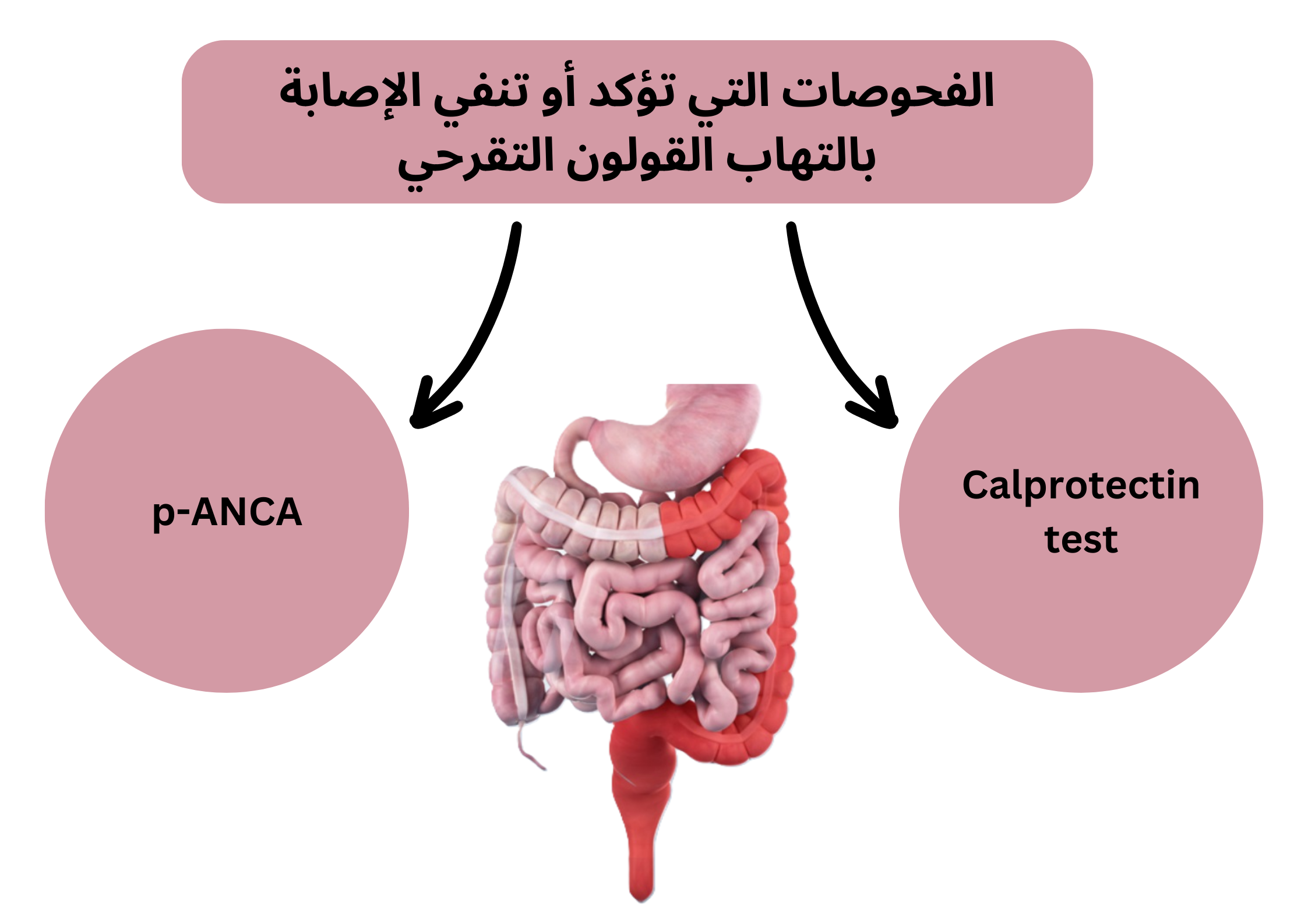 الفحوصات التي تؤكد أو تنفي الإصابة بالتهاب القولون التقرحي	