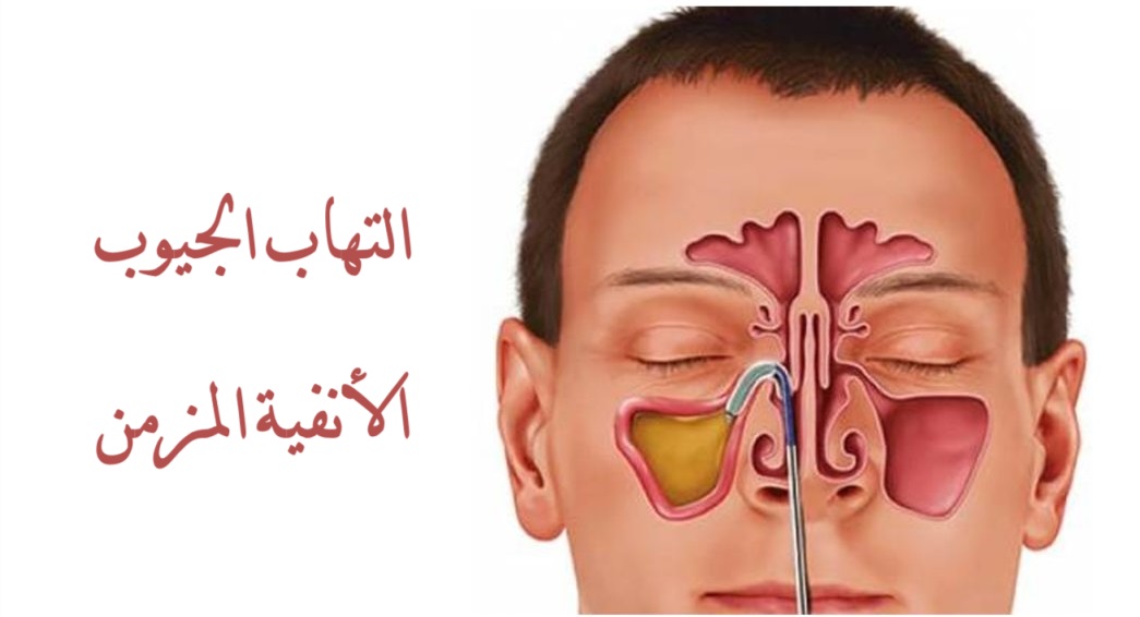 التهاب الجيوب الأنفية	