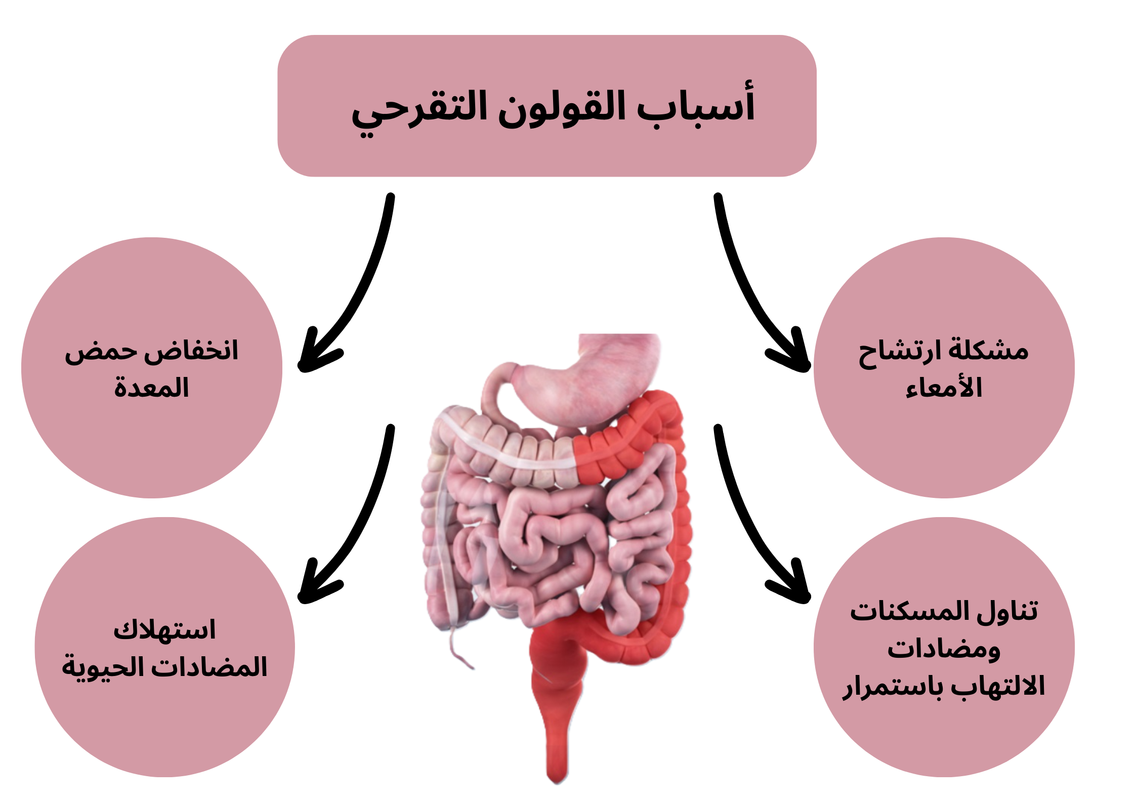أسباب القولون التقرحي	