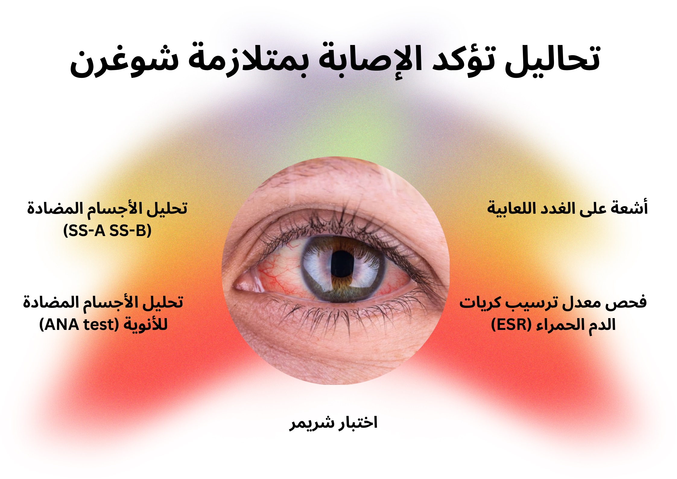 تحاليل تؤكد الإصابة بمتلازمة شوغرن	