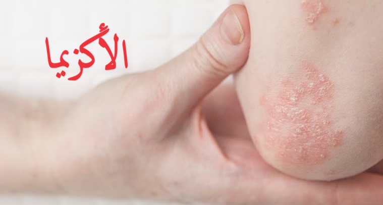 الأكزيما