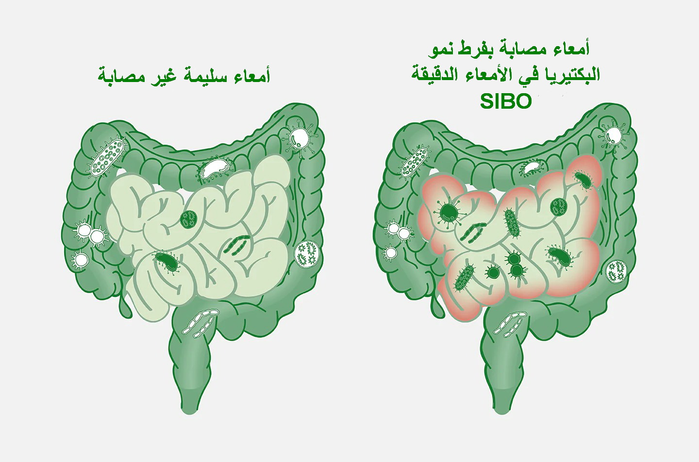 SIBO