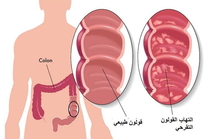 التهاب القولون التقرحي	