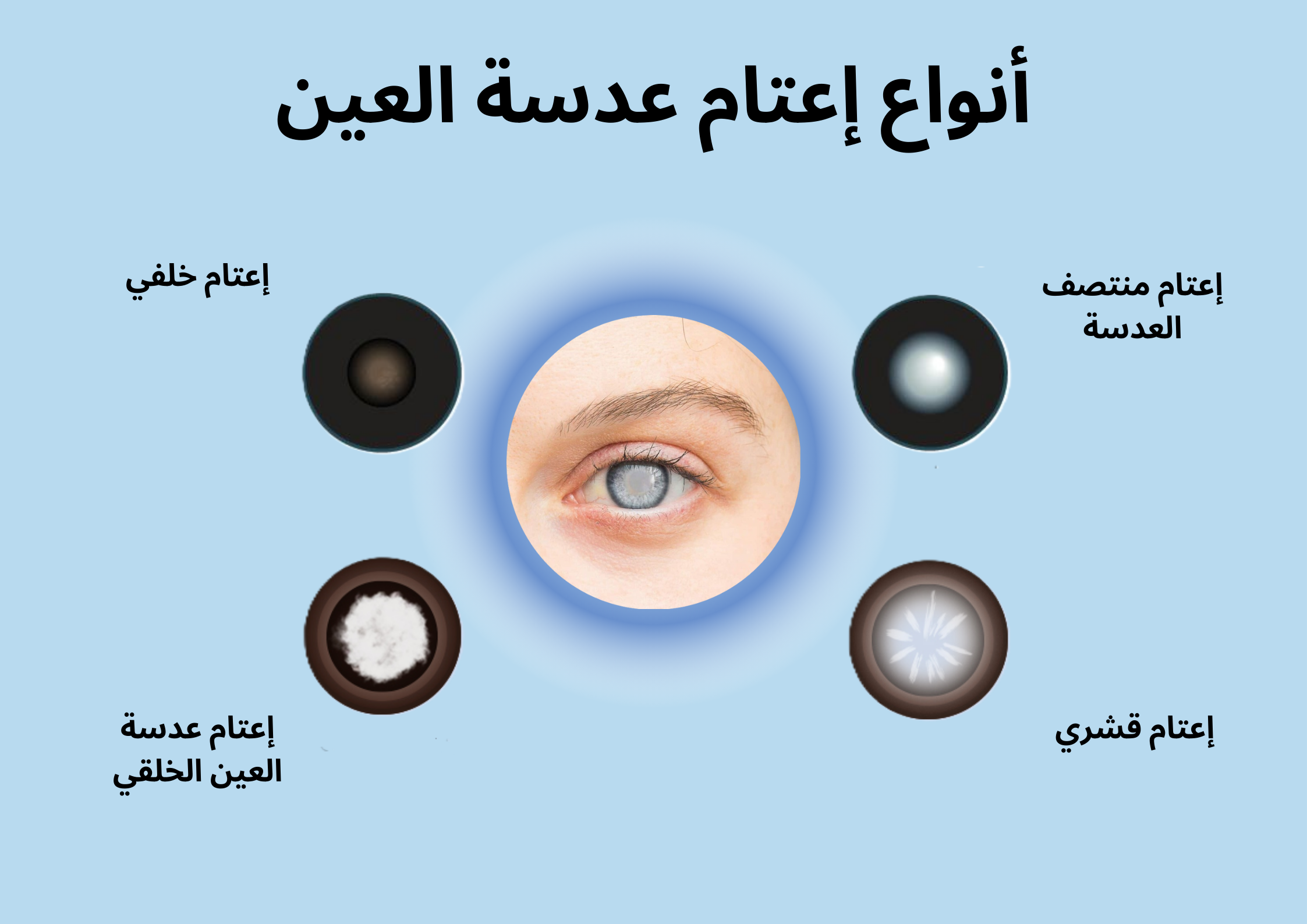 أنواع إعتام عدسة العين	