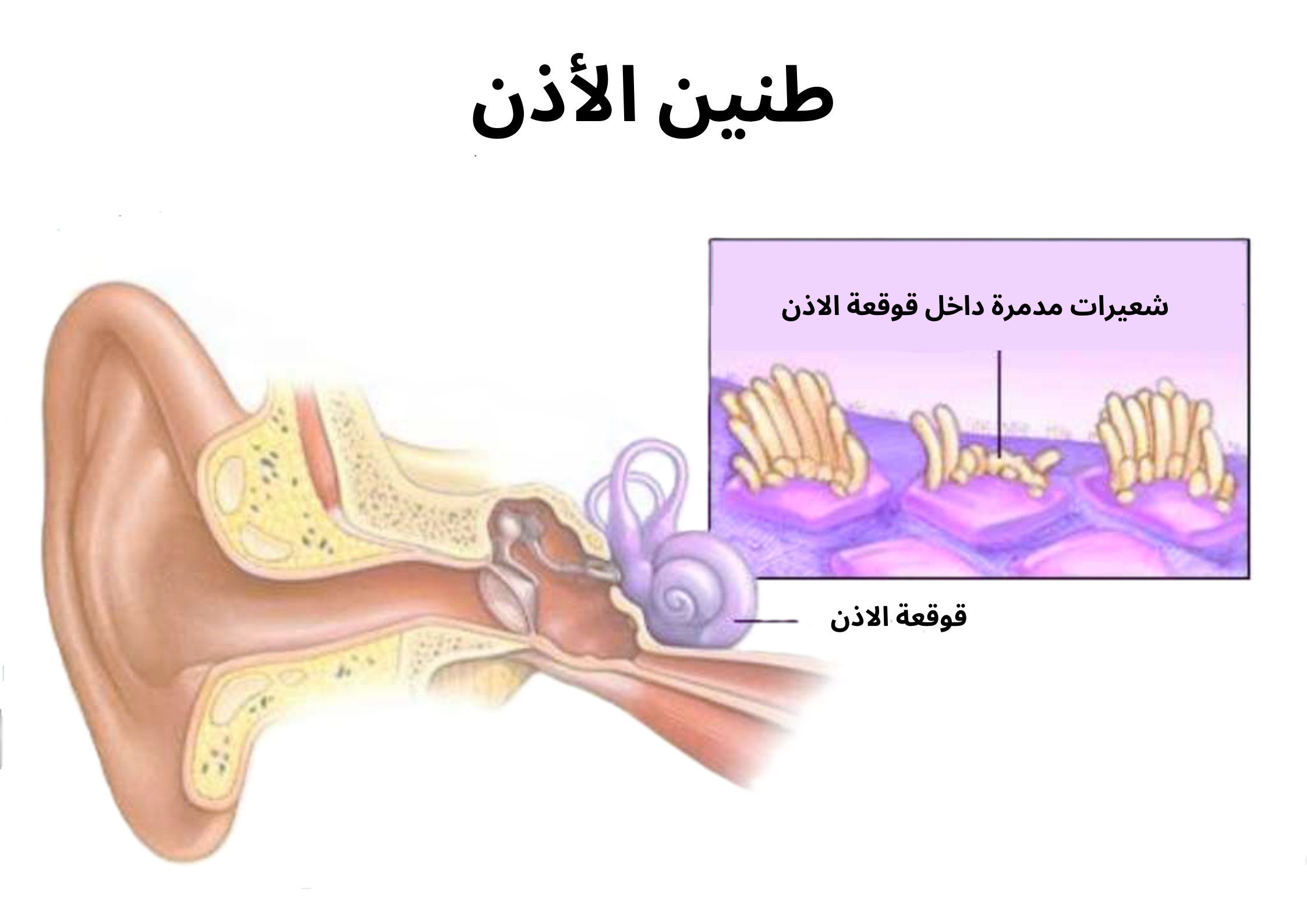 طنين الأذن