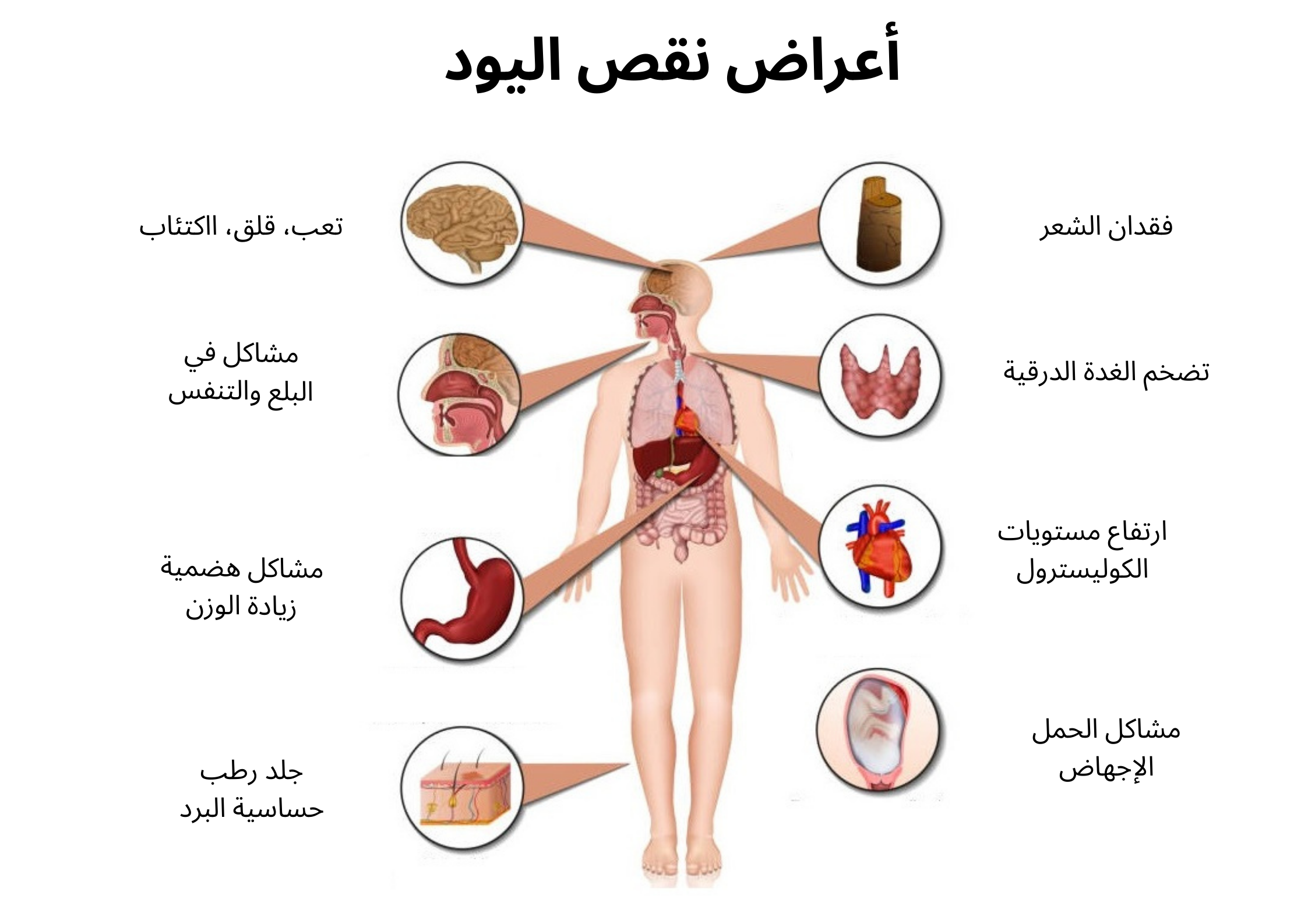 أعراض نقص اليود