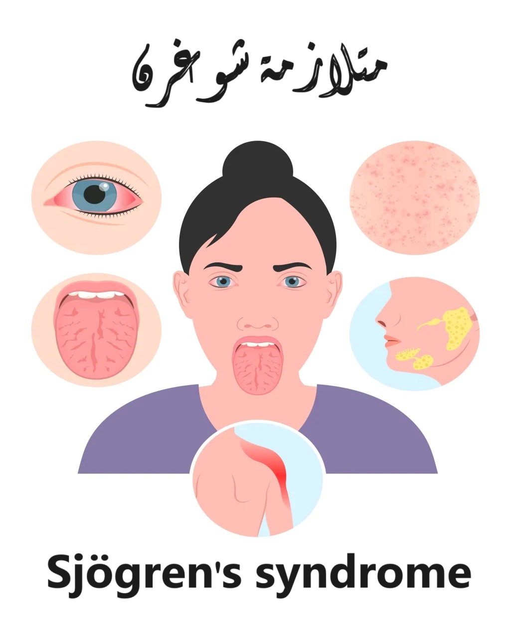 	Sjögren's syndrome متلازمة شوغرن