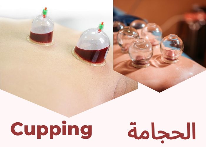 الحجامة cupping	