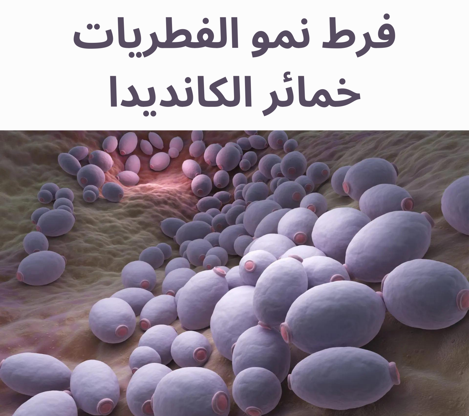 فرط نمو الفطريات SIFO خمائر الكانديدا	