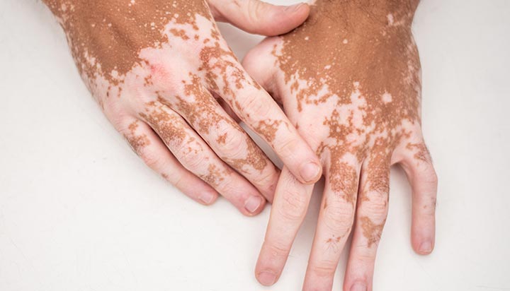 Vitiligo البهاق	