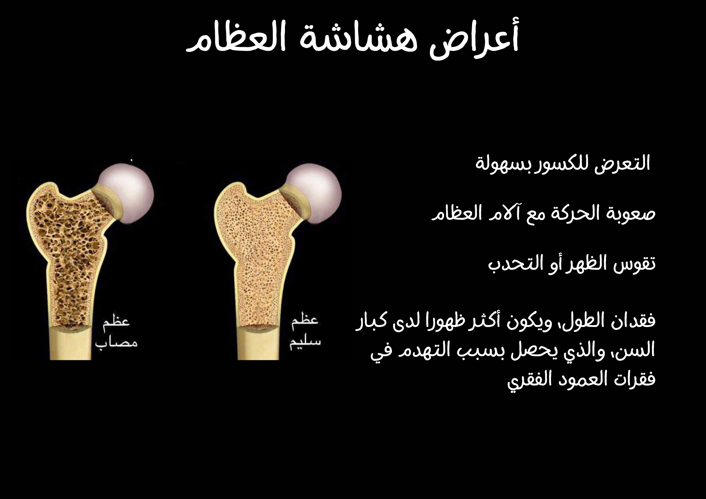 أكثر الأشخاص عرضة لهشاشة العظام	