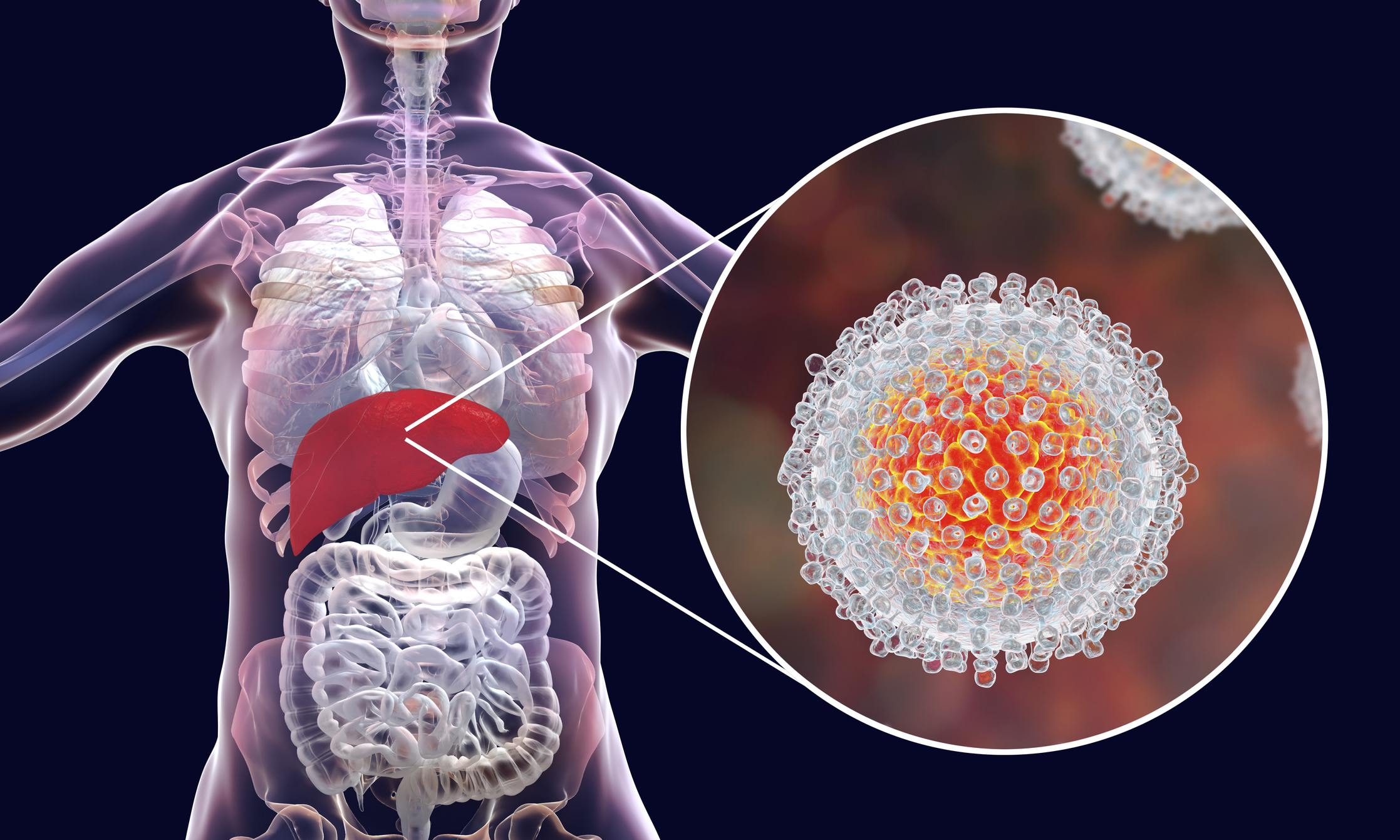 Hepatitis C التهاب الكبد الوبائي سي	