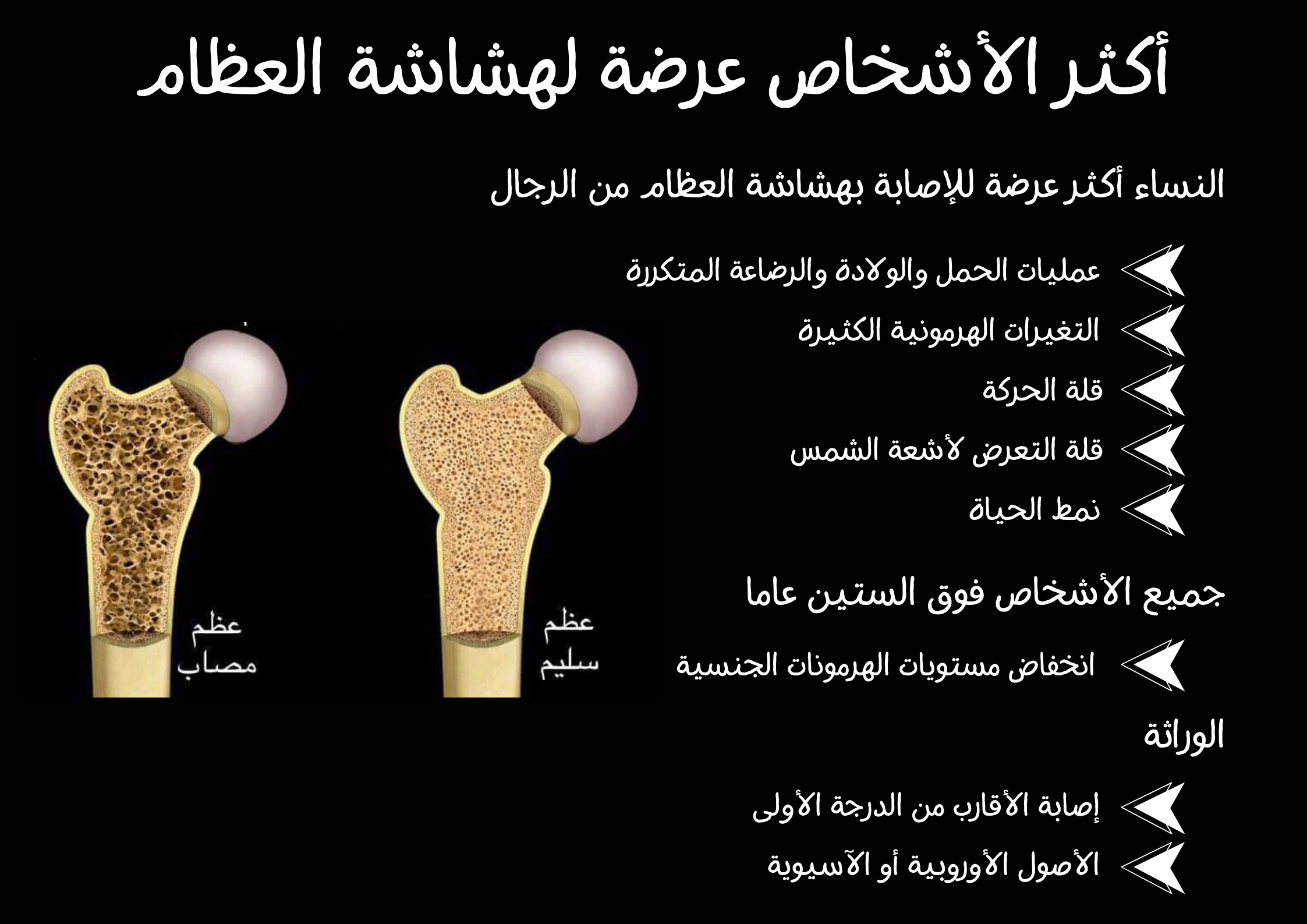 أكثر الأشخاص عرضة لهشاشة العظام	