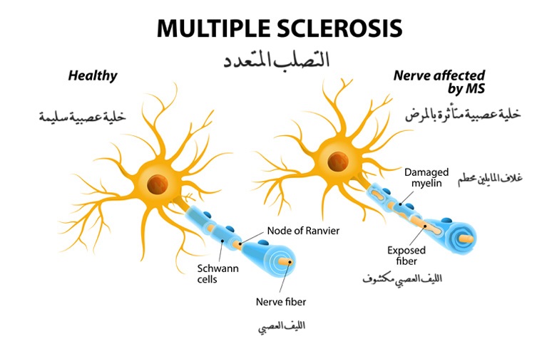 التصلب المتعدد