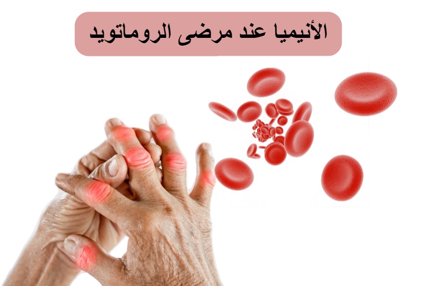الأنيميا عند مرضى الروماتويد	