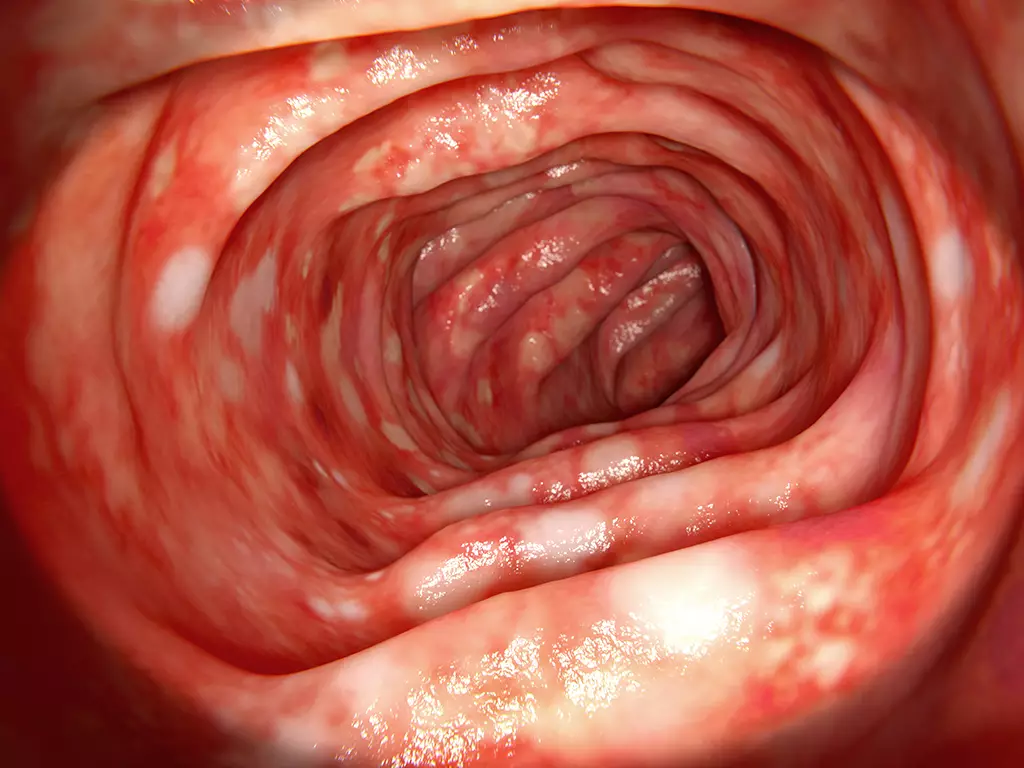 bowel inflammatory disease التهاب أمعاء	